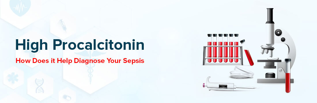 High Procalcitonin: How Does It Help Diagnose Your Sepsis